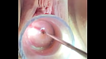 Hegar sound probing deep in cervix